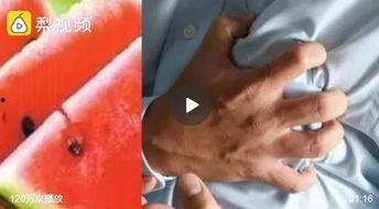 吃隔夜瓜导致小肠坏死,小肠坏死警示，食品安全需重视